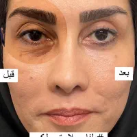 خال برداری، پاک کردن تتو، بلفاروپلاستی در تهران|خدمات آرایشگری و زیبایی|باقرشهر, |دیوار