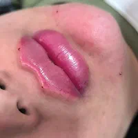 ژل بوتاکس سی سی ۵۰۰|خدمات آرایشگری و زیبایی|قرچک, میرزائی جنوبی|دیوار