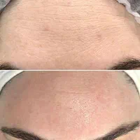 جشنواره اقساطی لیفت صورت|خدمات آرایشگری و زیبایی|تهران, نیلوفر|دیوار