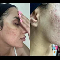 زیبایی.پی ارپی جوانسازی و ژل و بوتاکس.|خدمات آرایشگری و زیبایی|اصفهان, شهرک کاوه|دیوار