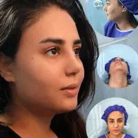 عمل بینی برای مراجعین الیگودرز/تهران/42میلیون