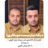 پروتز مو جای کاشت مو