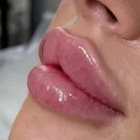 تزریق ژل و بوتاکس و prp صورت و مزو مو|خدمات آرایشگری و زیبایی|سبزوار, جوادیه شرقی|دیوار