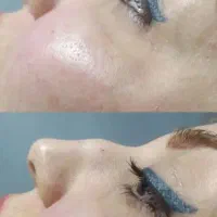 تزریق چربی .فیلر.نخ.ژل|خدمات آرایشگری و زیبایی|جهرم, |دیوار