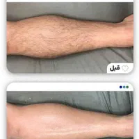 لیزر موج کندلا لیزر آقایان لیزر بانوان|خدمات آرایشگری و زیبایی|اصفهان, نقش جهان|دیوار