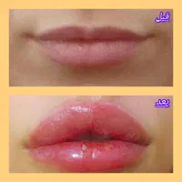 جشنواره تزریق ژل و بوتاکس وانزیم|خدمات آرایشگری و زیبایی|ملارد, |دیوار