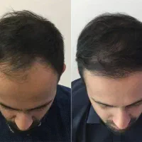 روغن کنجد درد بی درمون موهاته
