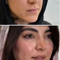 تزریق ژل فول فیس فیلر زیرچشم فیلربینی درکلینیک
