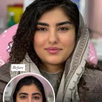 تزریق ژل و بوتاکس هایفو مزوژل|خدمات زیبایی و سلامت|تهران, شهرک شریعتی|دیوار