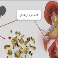 راه نمایی برای از بین بردن سنگ کلیه