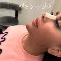 تزریق ژل بوتاکس نخ ...توسط پزشک در کلینیک سایماه