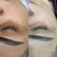 فیشال و پاکسازی پوست