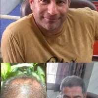 کاشت مو و کاشت اَبرو|خدمات آرایشگری و زیبایی|فسا, |دیوار