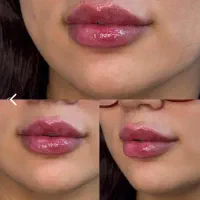 ژل و بوتاکس