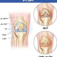 پیشگیری و کاهش دردهای آرتروز وروماتیسم باطب سنتی|آرایشی، بهداشتی، درمانی|گرگان, |دیوار