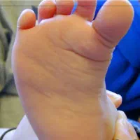 کلینیک تخصصی درمان کف پای صاف