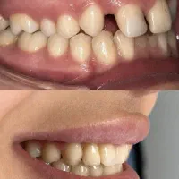 کامپوزیت فیسنیگ دندان لمینت ارتودنسی|خدمات زیبایی و سلامت|شیراز, معالیآباد|دیوار