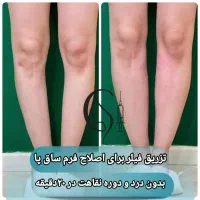فیلر بادی واقعی قیمت منصفانه + پرداخت شرایطی|آرایشی، بهداشتی، درمانی|تبریز, |دیوار