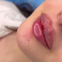 ژل بوتاکس نخ لیفت مزو زاویه|خدمات آرایشگری و زیبایی|تهران, سلسبیل|دیوار