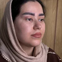 تزریق ژل بوتاکس هایفوتراپی بلفاروپلاستی توسط پزشک|خدمات آرایشگری و زیبایی|تبریز, |دیوار
