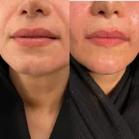 تزریق بایوفیلر کل صورت نچرال و طبیعی|خدمات آرایشگری و زیبایی|پاکدشت, پاکدشت (مامازند)|دیوار