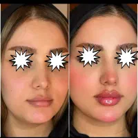 جشنواره تزریق ژل،بوتاکس،مزو،prp،انزیم