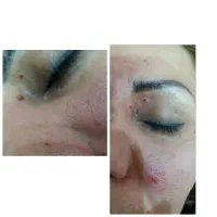 برداشتن خال ومنگوله های پوستی ولکه های سطحی بالیزر|خدمات آرایشگری و زیبایی|الیگودرز, |دیوار