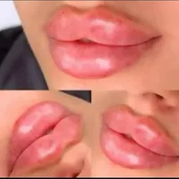 آموزش ژل و بوتاکس 2900.چال گونه.آموزش نخ 2500