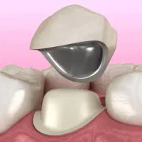 ساخت روکش دندان با تعرفه دولتی