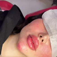 مطب پزشک.ژل وبوتاکس.لیفت بانخ.فیلربینی ژل آلت