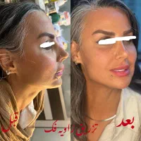 کیلینیک نوین تزریق ژل چربی بوتاکس مزو پی آرپی|خدمات آرایشگری و زیبایی|رشت, گلسار|دیوار