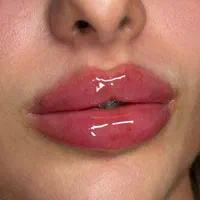 ژل لب،فیلرلب،بوتاکس،مزوتراپی
