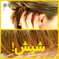 محلول ضد شپش از بین برنده تخم شپش (رشک) پنج دقیقه