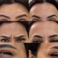 تخفیف ویژه صبح بوتاکس فول مصپورت۱/۴۹۰توسط پزشک