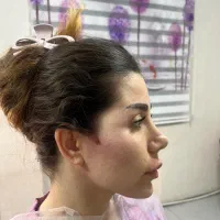 تزریق ژل و بوتاکس لیزر موهای زای|خدمات زیبایی و سلامت|تهران, نازیآباد|دیوار