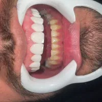 کامپوزیت/لمینیت/ایمپلنت/عصب کشی،و درمانی اقساطی|خدمات آرایشگری و زیبایی|مشهد, جنت|دیوار