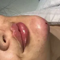 فیلر و بوتاکس فیلر بدن بادی۲۰۰ و ۲۵۰