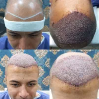 کاشت مو|خدمات آرایشگری و زیبایی|مشهد, راهنمایی|دیوار