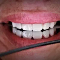 کامپوزیت دیجیتال و لمینیت با شرایط استثنایی در لار|خدمات آرایشگری و زیبایی|لار, |دیوار