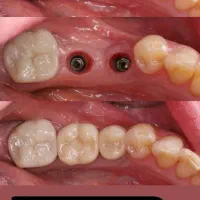 دندانپزشکی و شرایط اقساطی بدون بهره ایمپلنت|خدمات آرایشگری و زیبایی|تبریز, |دیوار