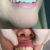 تخفیف وام دندانپزشکی ایمپلنت کامپوزیت روکش عصب کشی|خدمات آرایشگری و زیبایی|بروجرد, |دیوار