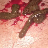 ماساژ درمانی زالو درمانی حجامت درمانی