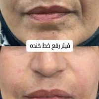 جشنواره آف ژل و بوتاکس|خدمات آرایشگری و زیبایی|شیراز, خلدبرین|دیوار