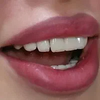 جشنواره دندانپزشکی،کامپوزیت،لمینت|خدمات آرایشگری و زیبایی|تبریز, |دیوار
