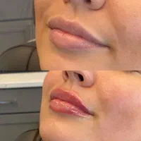 پی ارپی بوتاکس چانه هایفوفیلر لب چانه گونه لیفت نخ|خدمات آرایشگری و زیبایی|مشهد, هنرستان|دیوار