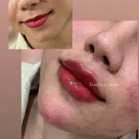 تزریق فیلر و بوتاکس