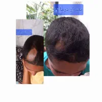 پرپشت شدن مو و رویش موی جدید|آرایشی، بهداشتی، درمانی|گناباد, |دیوار