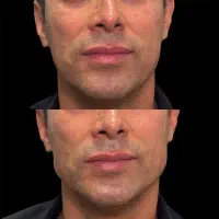 جشنواره  تزریق ژل  لب روسی وبوتاکس انزیم فیلر|خدمات آرایشگری و زیبایی|کرج, گلشهر|دیوار