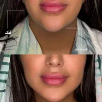 تزریق لب روسی/فیلر بادی/بوتاکس/مزوژل/prp|خدمات آرایشگری و زیبایی|تهران, تهرانپارس غربی|دیوار