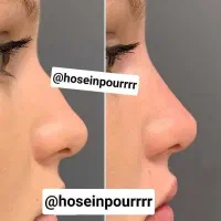کرم لیفت بینی